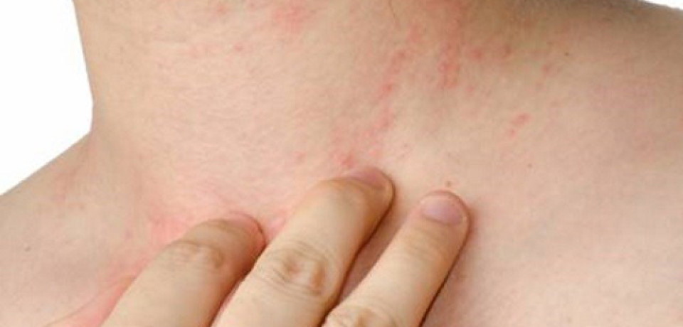Brasil vai enfrentar primeiro verão com dengue, chikungunya e Zika