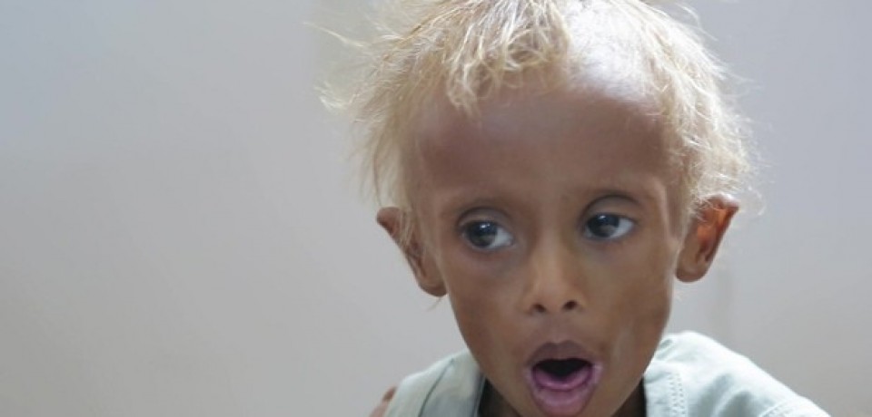 Vítimas da guerra, 1,5 milhão de crianças passam fome no Iêmen